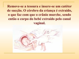 Remove-se a tesoura e insere-se um catéter de sucção. O cérebro da criança é extraído, o que faz com que o crânio murche, sendo então o corpo do bebé extraído pelo canal vaginal. 