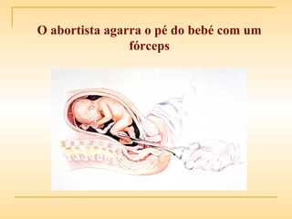O abortista agarra o pé do bebé com um fórceps 