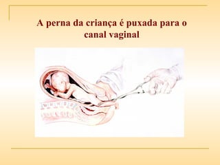 A perna da criança é puxada para o canal vaginal 