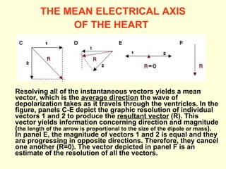 THE MEAN ELECTRICAL AXIS OF THE HEART   Resolving all of the instantaneous vectors yields a mean vector, which is the  average direction  the wave of depolarization takes as it travels through the ventricles. In the figure, panels C-E depict the graphic resolution of individual vectors 1 and 2 to produce the  resultant vector  (R). This vector yields information concerning direction and magnitude ( the length of the arrow is proportional to the size of the dipole or mass ). In panel E, the magnitude of vectors 1 and 2 is equal and they are progressing in opposite directions. Therefore, they cancel one another (R=0). The vector depicted in panel F is an estimate of the resolution of all the vectors.   