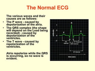 The Normal ECG The various waves and their causes are as follows: The P wave  -  caused by depolarization of the atria.  The QRS complex (the shape will depend on the Lead being recorded)  -  caused by depolarization of the ventricles.  The T wave  -  caused by repolarization of the ventricles. Atria repolarize while the QRS is occurring, so no wave is evident.  