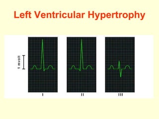 Left  Ventricular Hypertrophy 