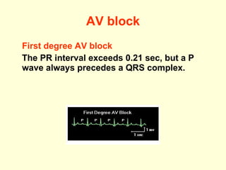 AV block First degree AV block The PR interval exceeds 0.21 sec, but a P wave always precedes a QRS complex. 