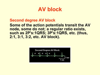 AV block Second degree AV block Some of the action potentials transit the AV node, some do not; a regular ratio exists, such as 2P's:1QRS; 3P's:1QRS, etc. (t hus, 2:1, 3:1, 3:2, etc. AV block ) . 