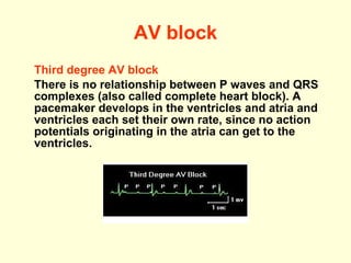 AV block Third degree AV block There is no relationship between P waves and QRS complexes (also called complete heart block). A pacemaker develops in the ventricles and atria and ventricles each set their own rate, since no action potentials originating in the atria can get to the ventricles.  