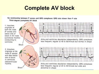 Complete AV block 