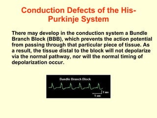 Conduction Defects of the His-Purkinje System There may develop in the conduction system a Bundle Branch Block (BBB), which prevents the action potential from passing through that particular piece of tissue.  As a result, the tissue distal to the block will not depolarize via the normal pathway, nor will the normal timing of depolarization occur.  