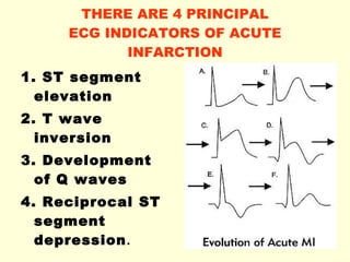 THERE ARE 4 PRINCIPAL ECG INDICATORS OF ACUTE INFARCTION 1. ST segment elevation  2. T wave inversion  3. Development of Q waves  4. Reciprocal ST segment depression .   