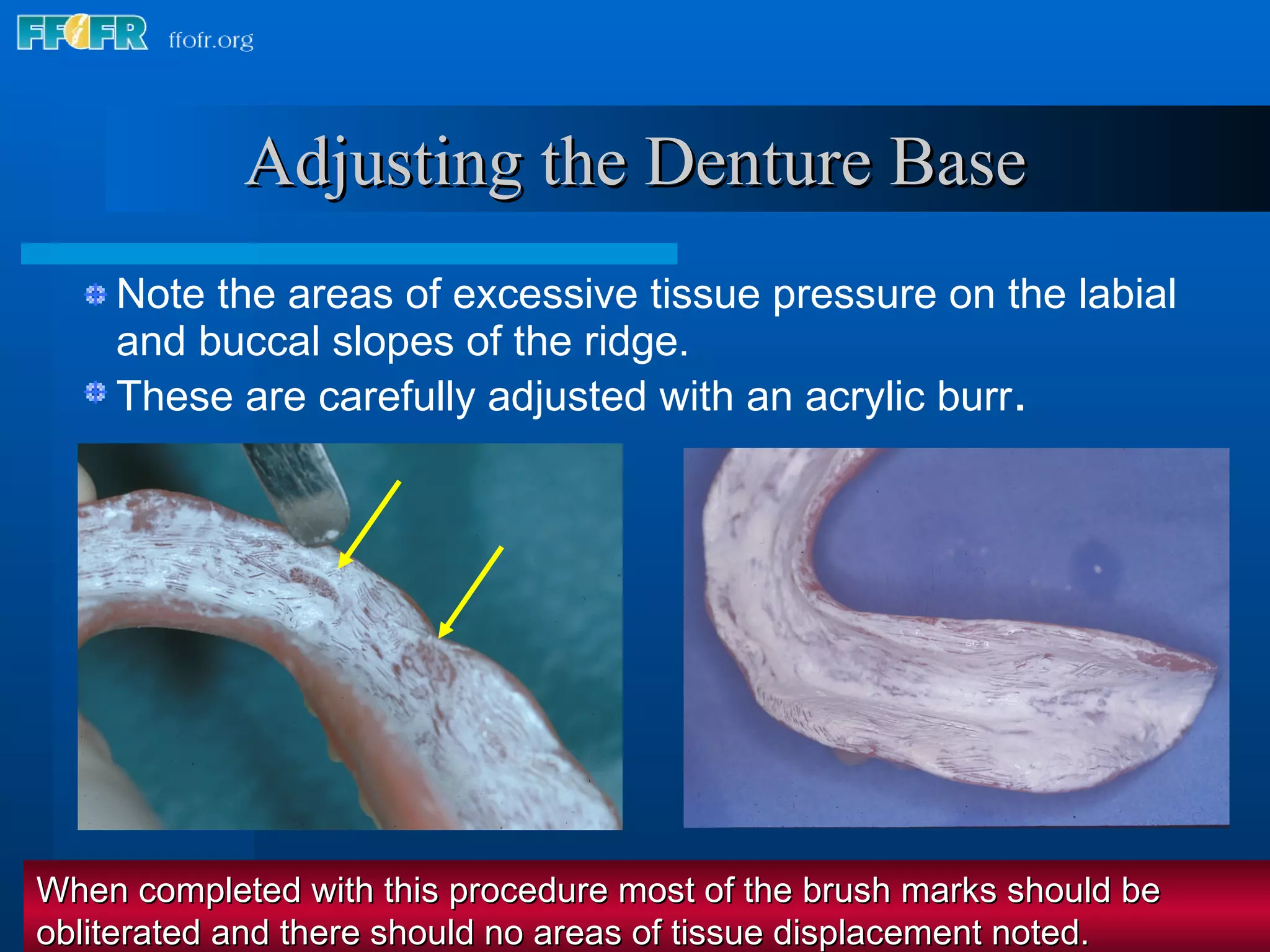 Note the areas of excessive tissue pressure on the labial and buccal slopes of the ridge. These are carefully adjusted with an acrylic burr . Adjusting the Denture Base When completed with this procedure most of the brush marks should be obliterated and there should no areas of tissue displacement noted. 