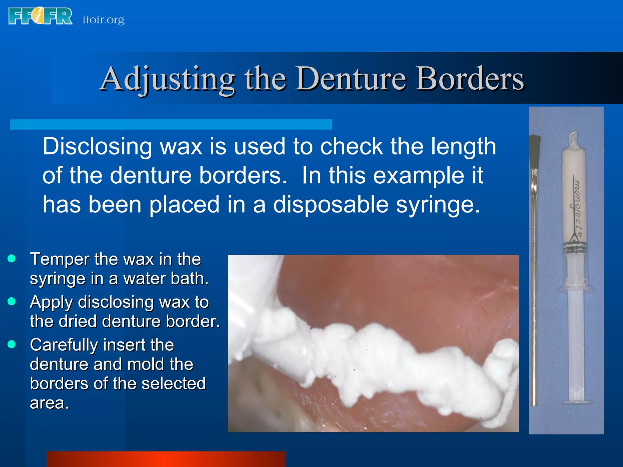 Adjusting the Denture Borders Temper the wax in the syringe in a water bath. Apply disclosing wax to the dried denture border. Carefully insert the denture and mold the borders of the selected area. Disclosing wax is used to check the length of the denture borders.  In this example it has been placed in a disposable syringe. 