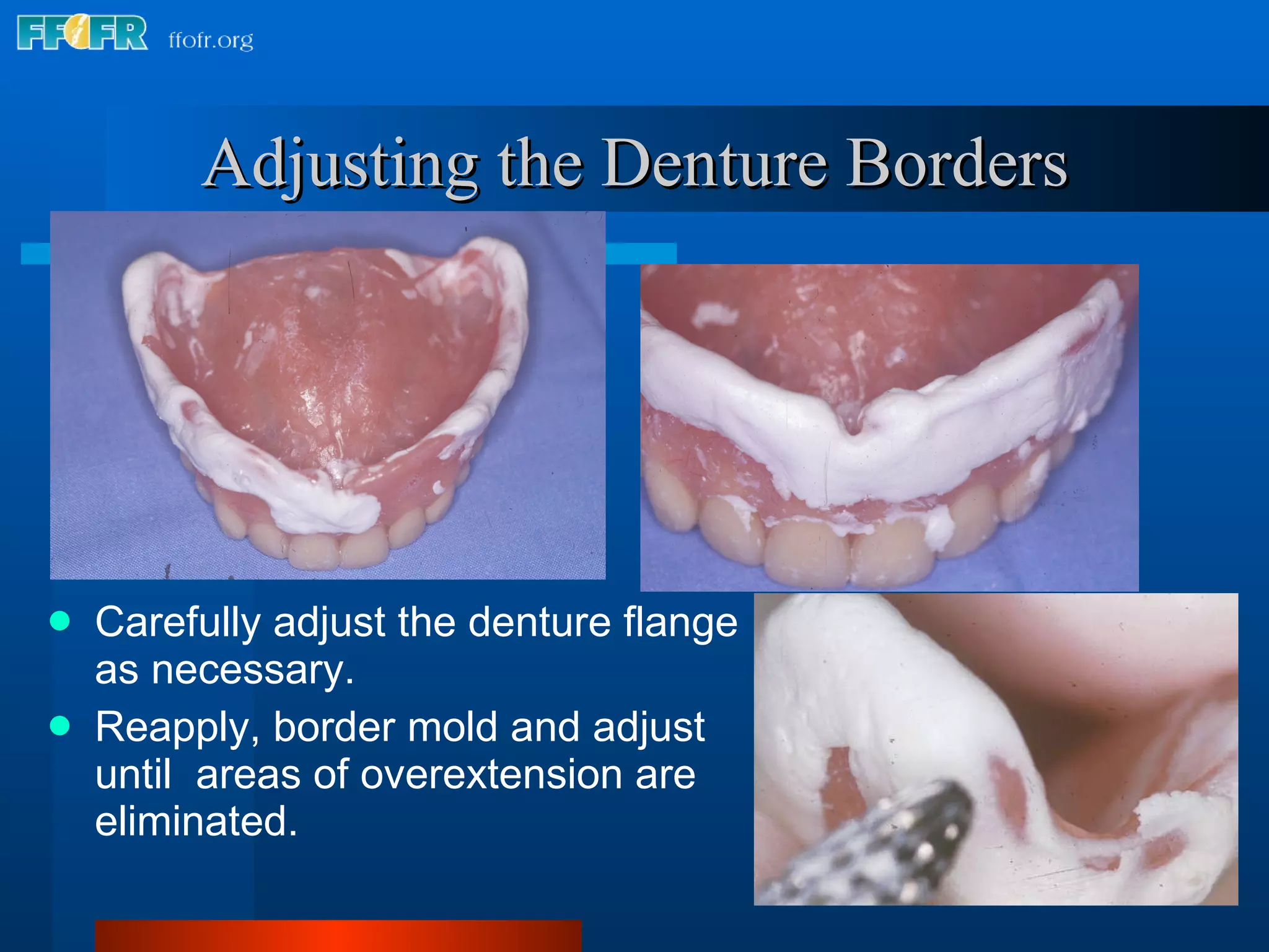Carefully adjust the denture flange as necessary. Reapply, border mold and adjust until  areas of overextension are eliminated. Adjusting the Denture Borders 
