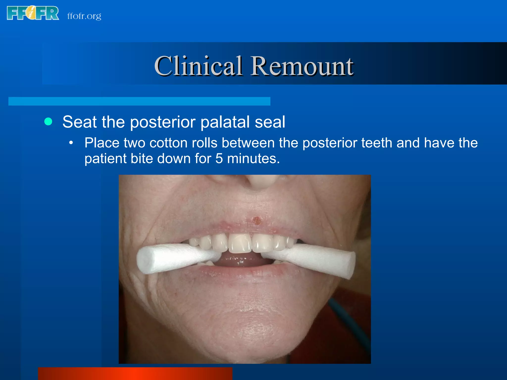 Clinical Remount Seat the posterior palatal seal Place two cotton rolls between the posterior teeth and have the patient bite down for 5 minutes. 