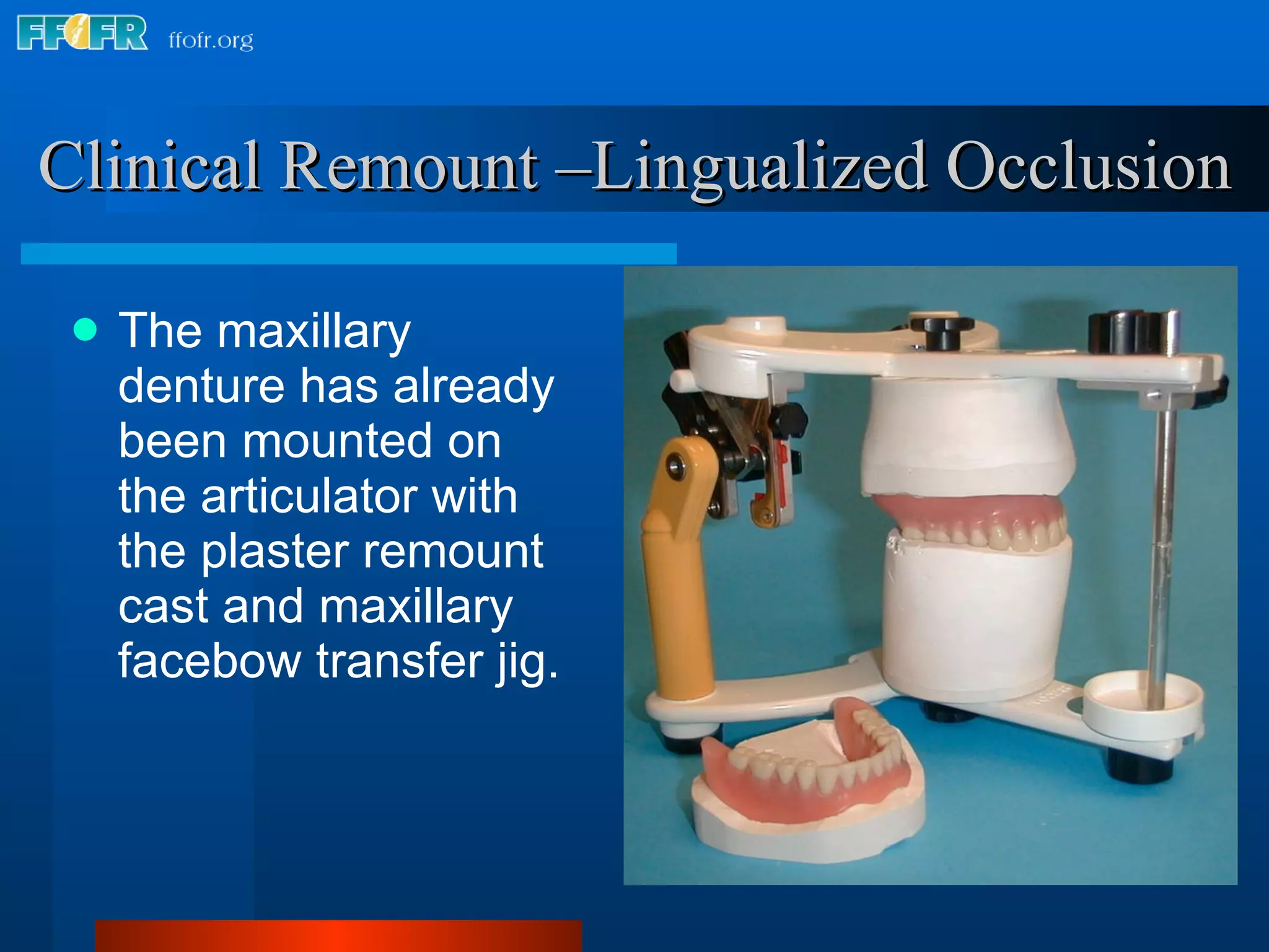The maxillary denture has already been mounted on the articulator with the plaster remount  cast and maxillary facebow transfer jig. Clinical Remount –Lingualized Occlusion 