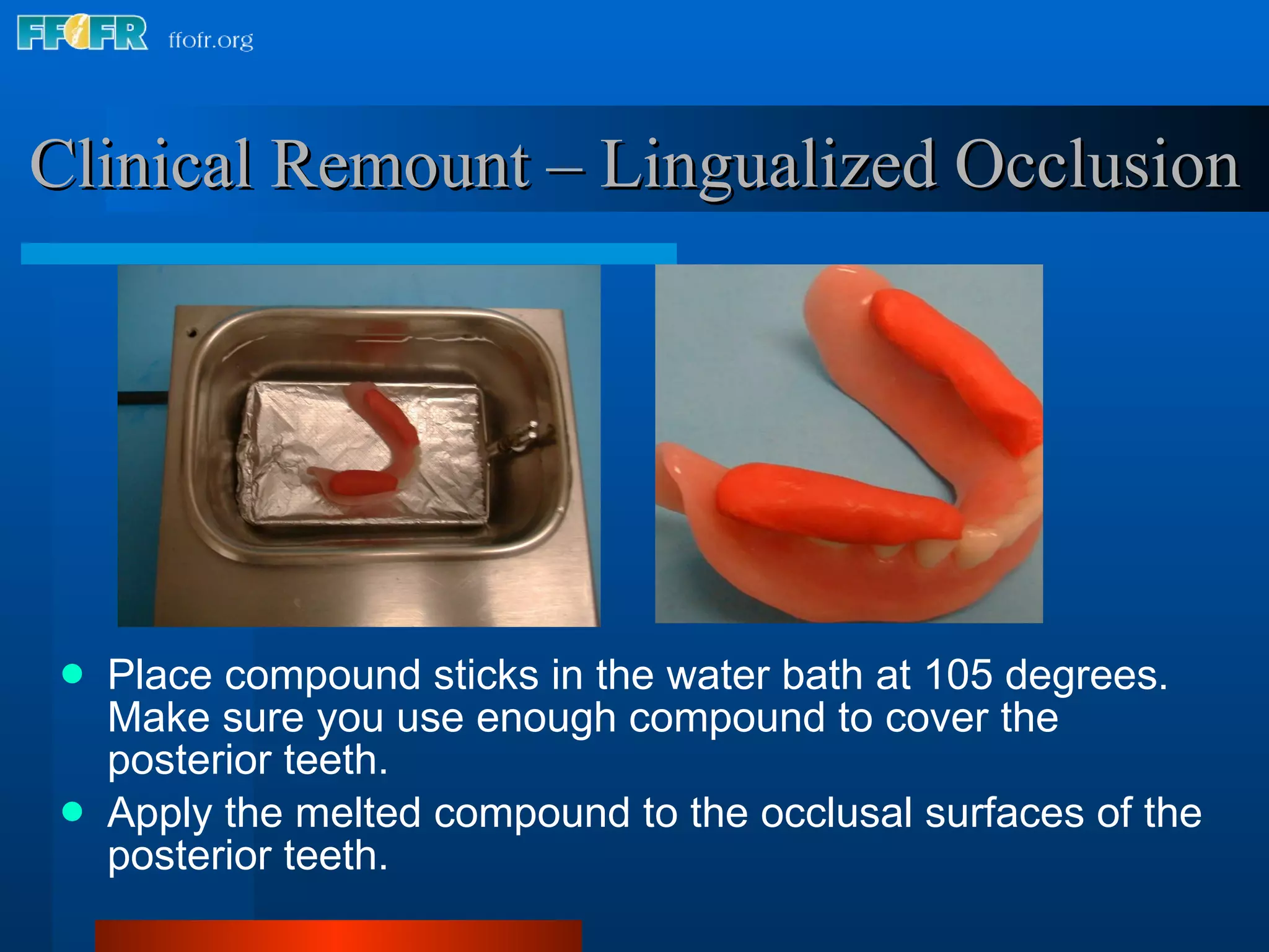 Place compound sticks in the water bath at 105 degrees.  Make sure you use enough compound to cover the posterior teeth. Apply the melted compound to the occlusal surfaces of the posterior teeth. Clinical Remount – Lingualized Occlusion 