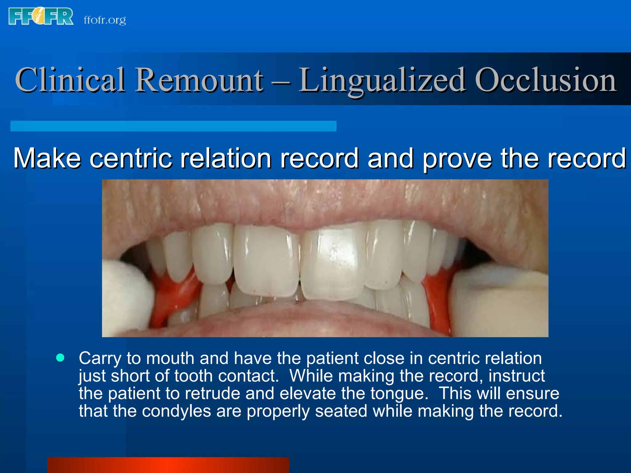 Carry to mouth and have the patient close in centric relation just short of tooth contact.  While making the record, instruct the patient to retrude and elevate the tongue.  This will ensure that the condyles are properly seated while making the record. Clinical Remount – Lingualized Occlusion Make centric relation record and prove the record 