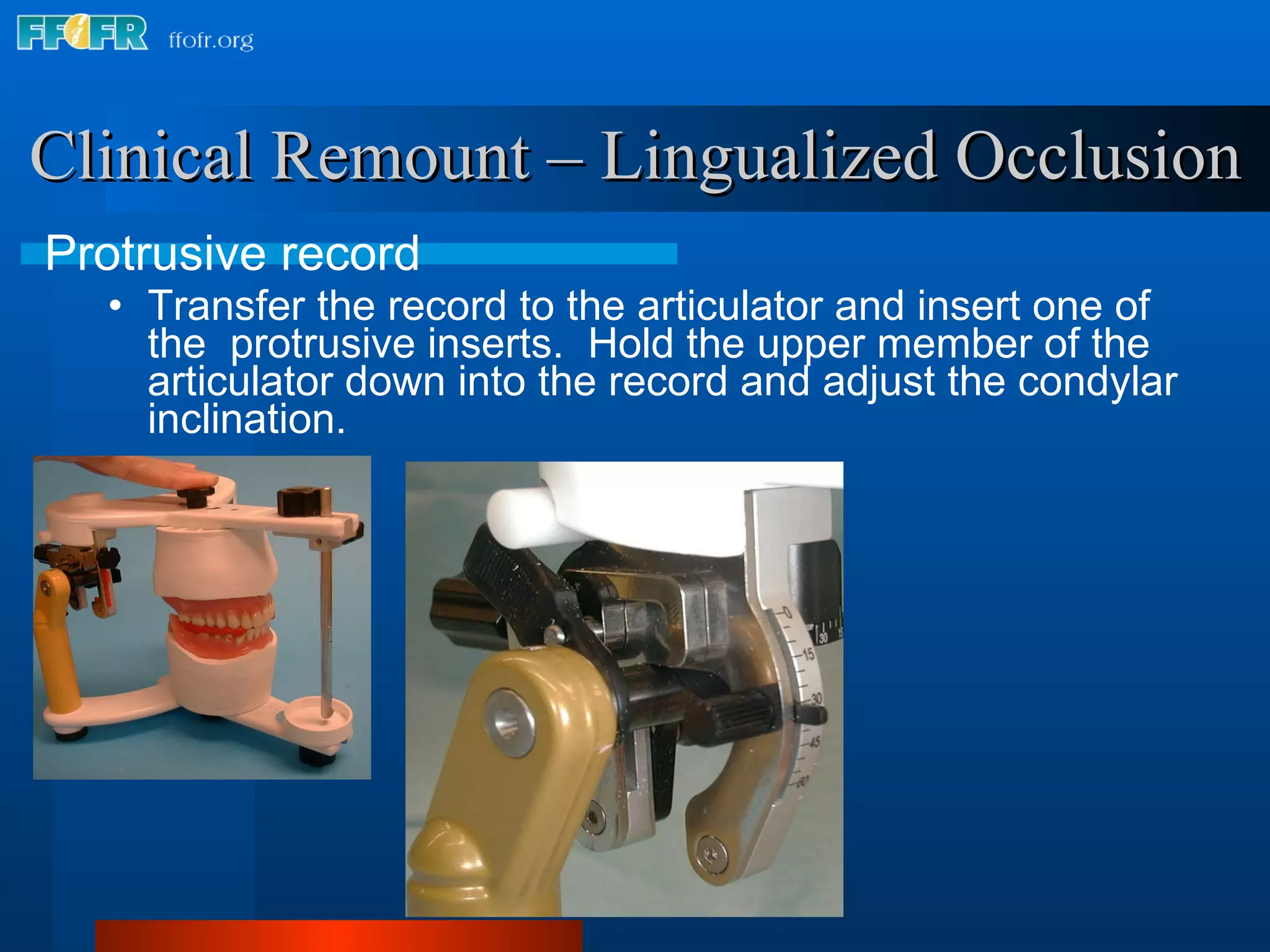 Clinical Remount – Lingualized Occlusion Protrusive record Transfer the record to the articulator and insert one of  the  protrusive inserts.  Hold the upper member of the articulator down into the record and adjust the condylar inclination. 