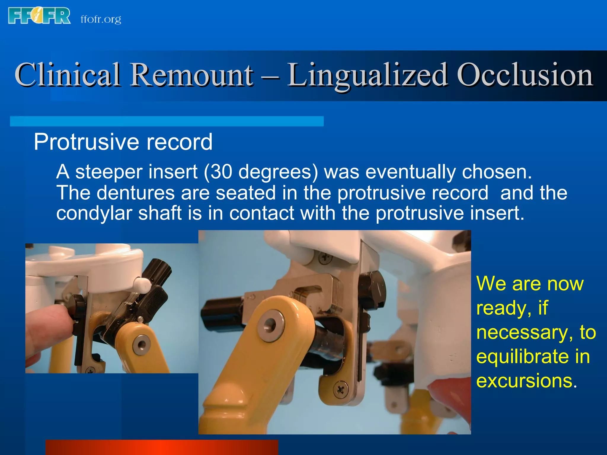 Clinical Remount – Lingualized Occlusion Protrusive record A steeper insert (30 degrees) was eventually chosen.  The dentures are seated in the protrusive record  and the condylar shaft is in contact with the protrusive insert. We are now ready, if necessary, to equilibrate in excursions . 