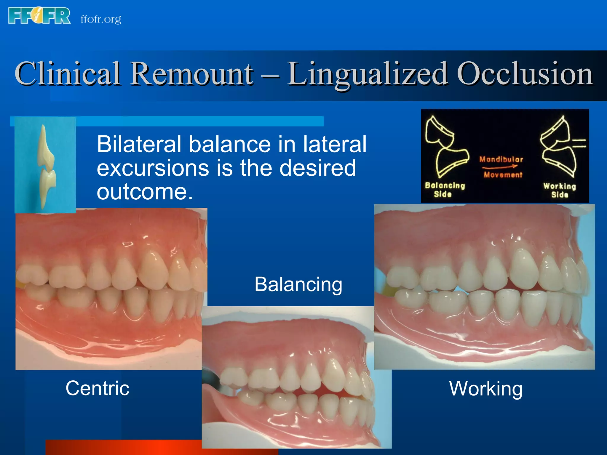 Clinical Remount – Lingualized Occlusion Bilateral balance in lateral excursions is the desired outcome. Working Balancing Centric 