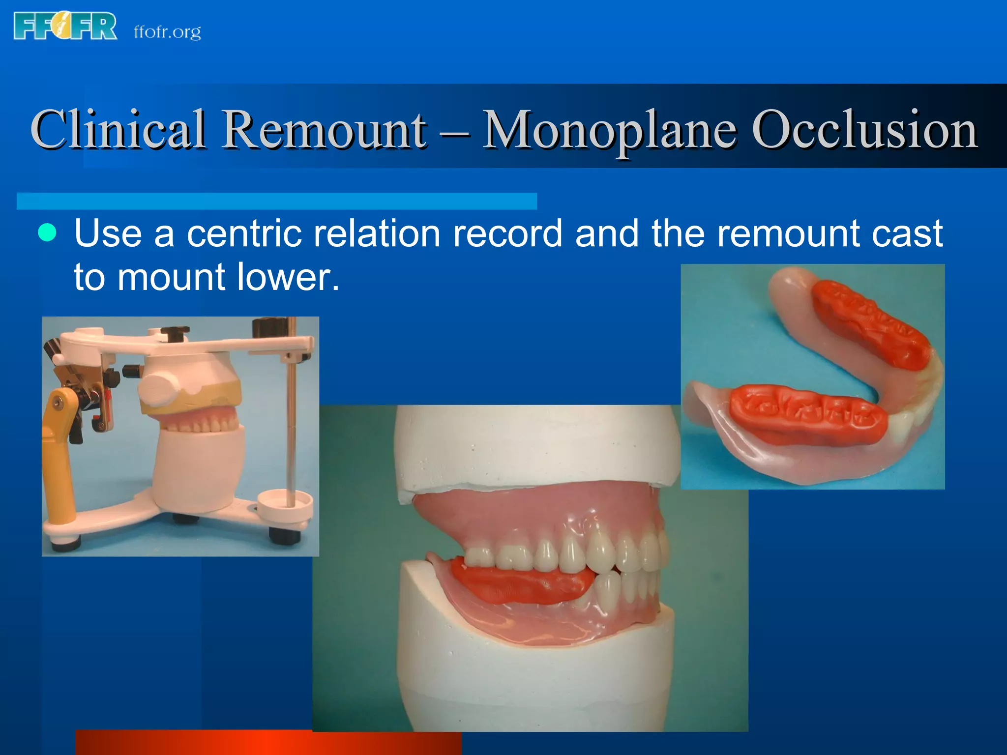 Clinical Remount – Monoplane Occlusion Use a centric relation record and the remount cast to mount lower. 