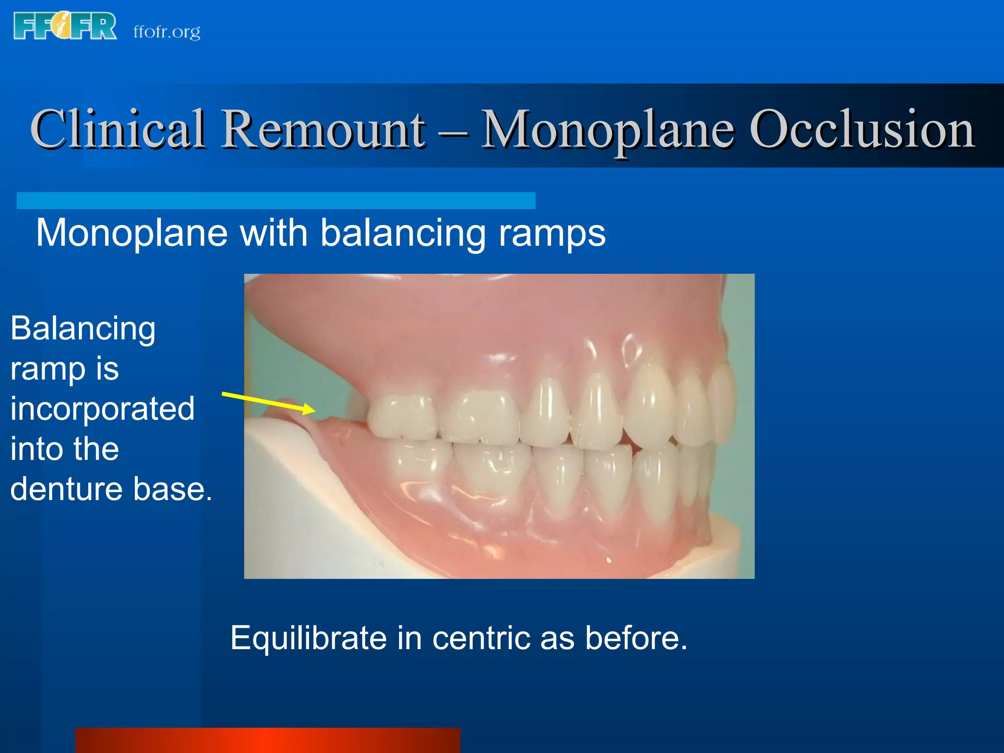 Clinical Remount – Monoplane Occlusion Monoplane with balancing ramps Equilibrate in centric as before. Balancing ramp is incorporated into the denture base . 
