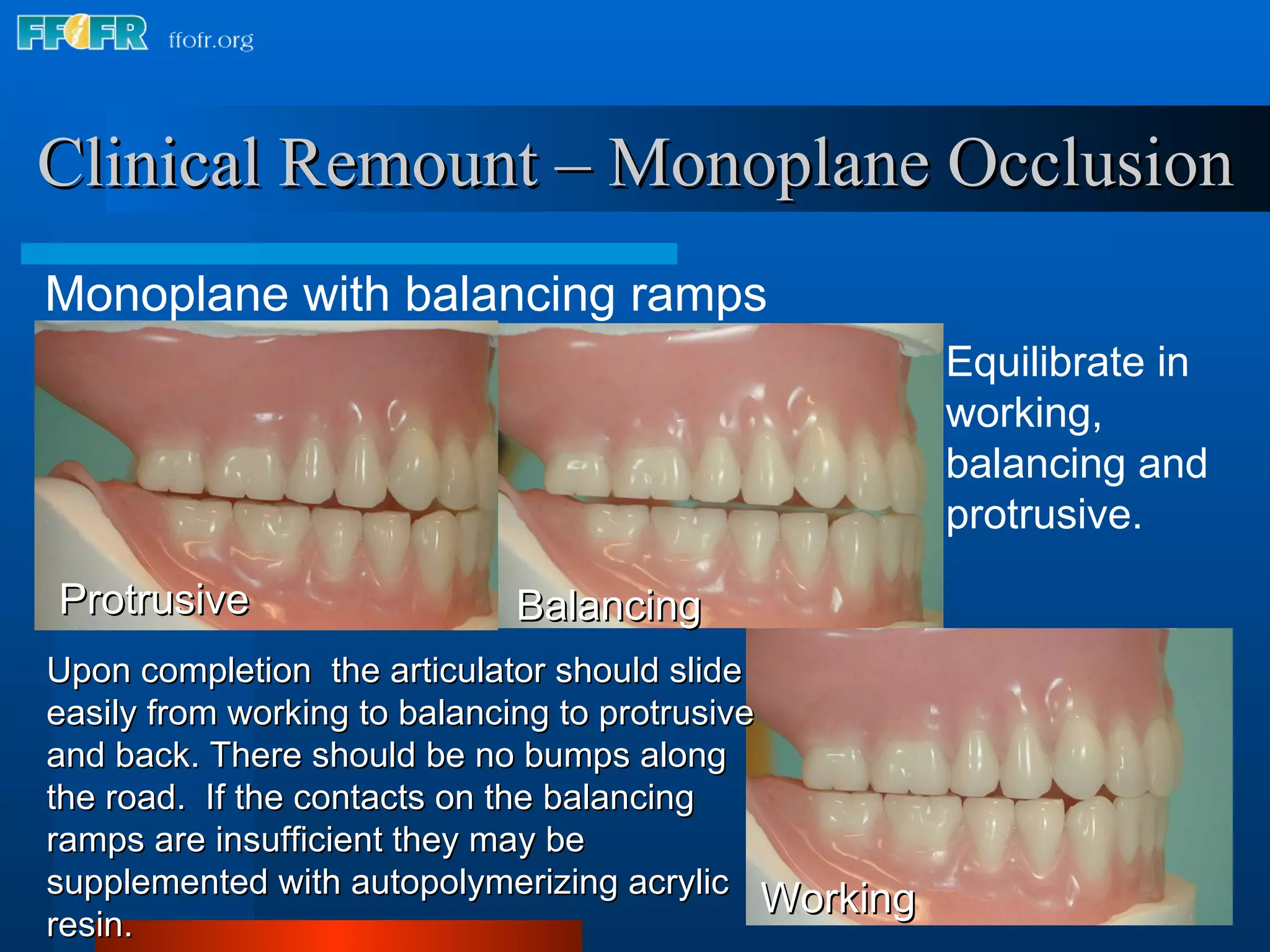 Clinical Remount – Monoplane Occlusion Monoplane with balancing ramps Equilibrate in working, balancing and protrusive. Upon completion  the articulator should slide easily from working to balancing to protrusive and back. There should be no bumps along the road.  If the contacts on the balancing ramps are insufficient they may be supplemented with autopolymerizing acrylic resin. Balancing Protrusive Working 