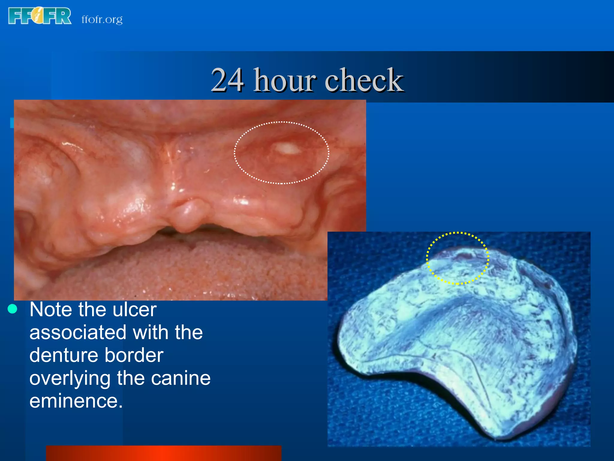 24 hour check Note the ulcer associated with the denture border overlying the canine eminence. 