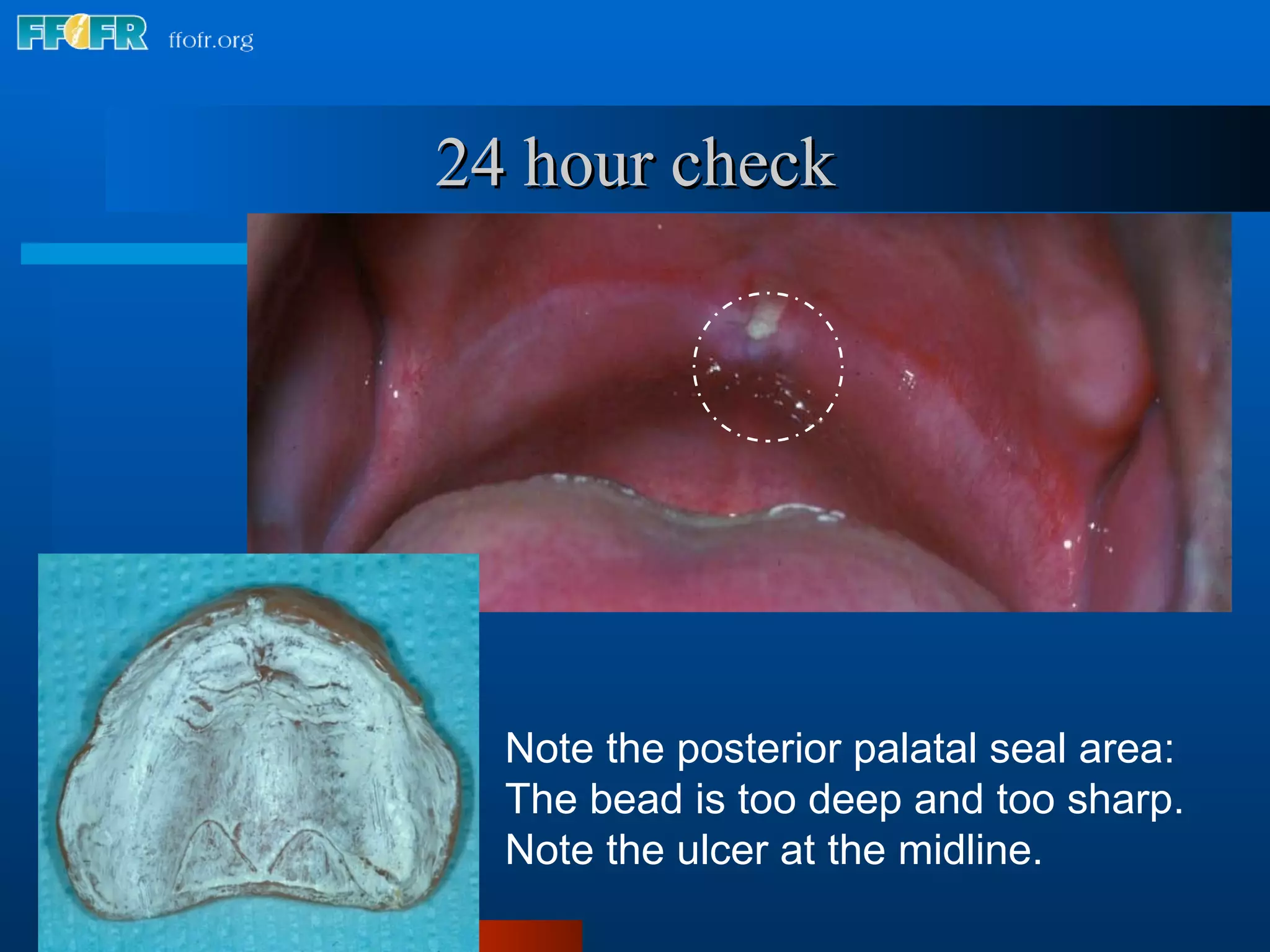 Note the posterior palatal seal area: The bead is too deep and too sharp.  Note the ulcer at the midline. 24 hour check 