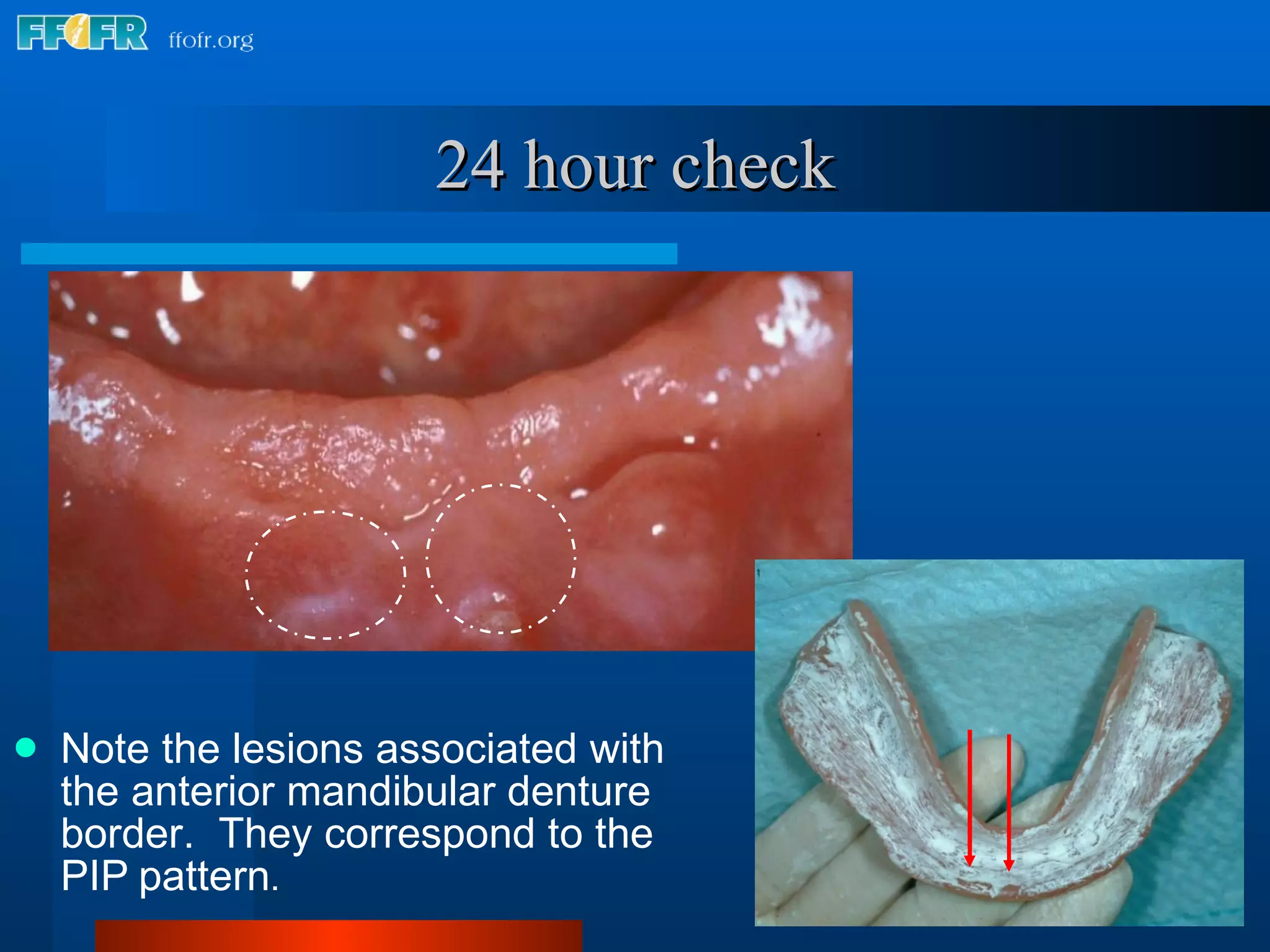 24 hour check Note the lesions associated with the anterior mandibular denture border.  They correspond to the PIP   pattern . 