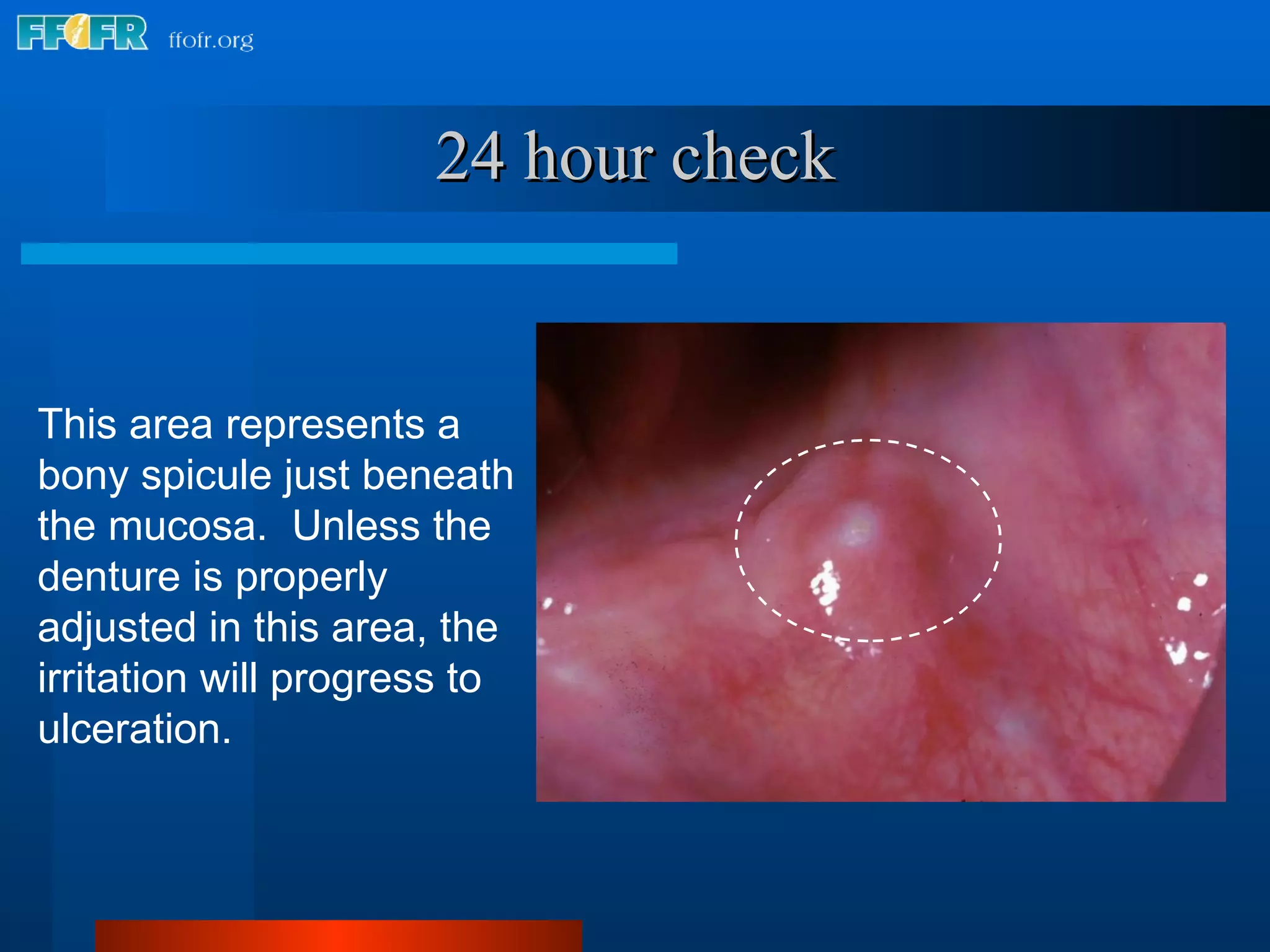 24 hour check This area represents a bony spicule just beneath the mucosa.  Unless the denture is properly adjusted in this area, the irritation will progress to ulceration. 