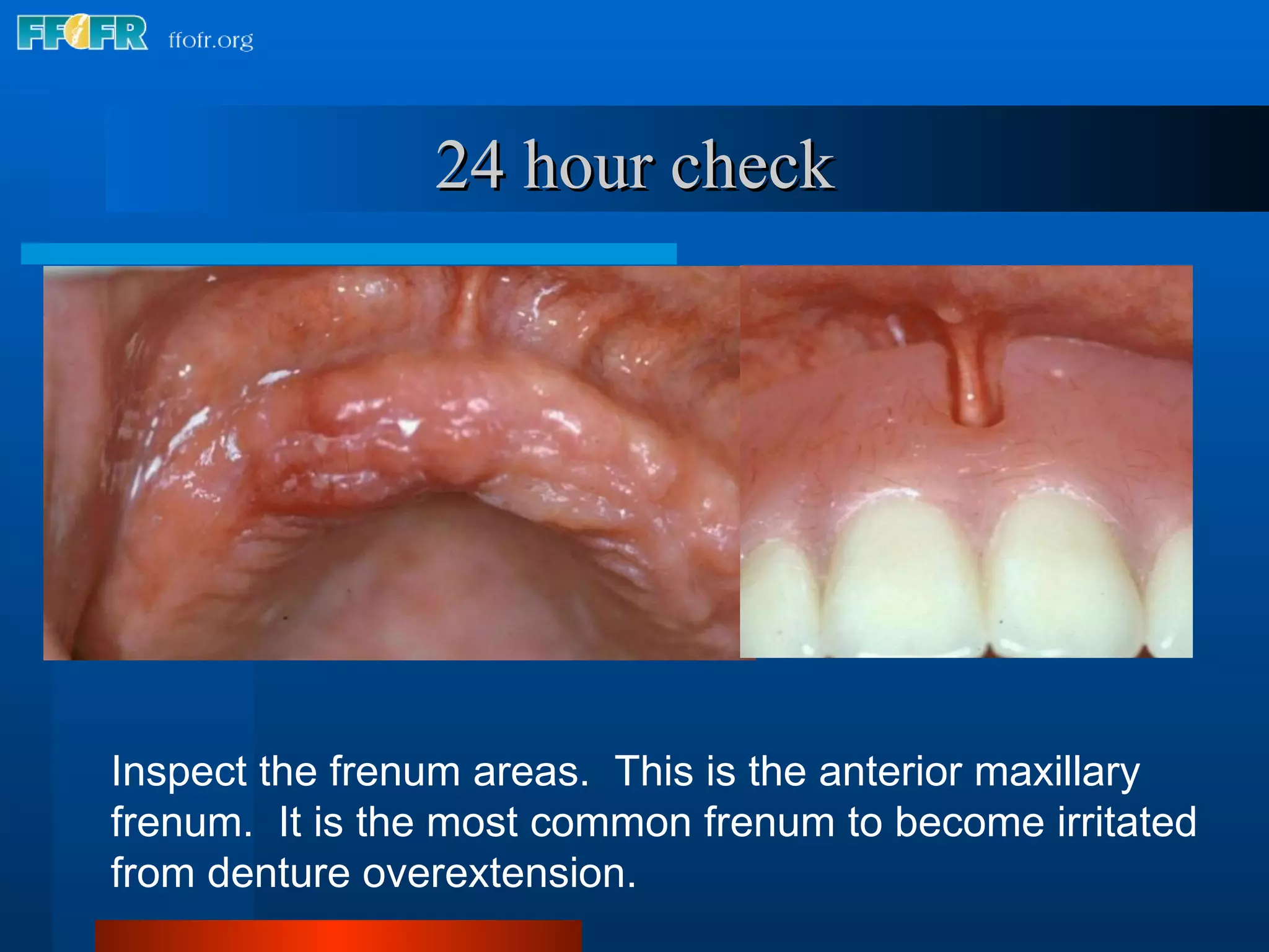 24 hour check Inspect the frenum areas.  This is the anterior maxillary frenum.  It is the most common frenum to become irritated from denture overextension. 