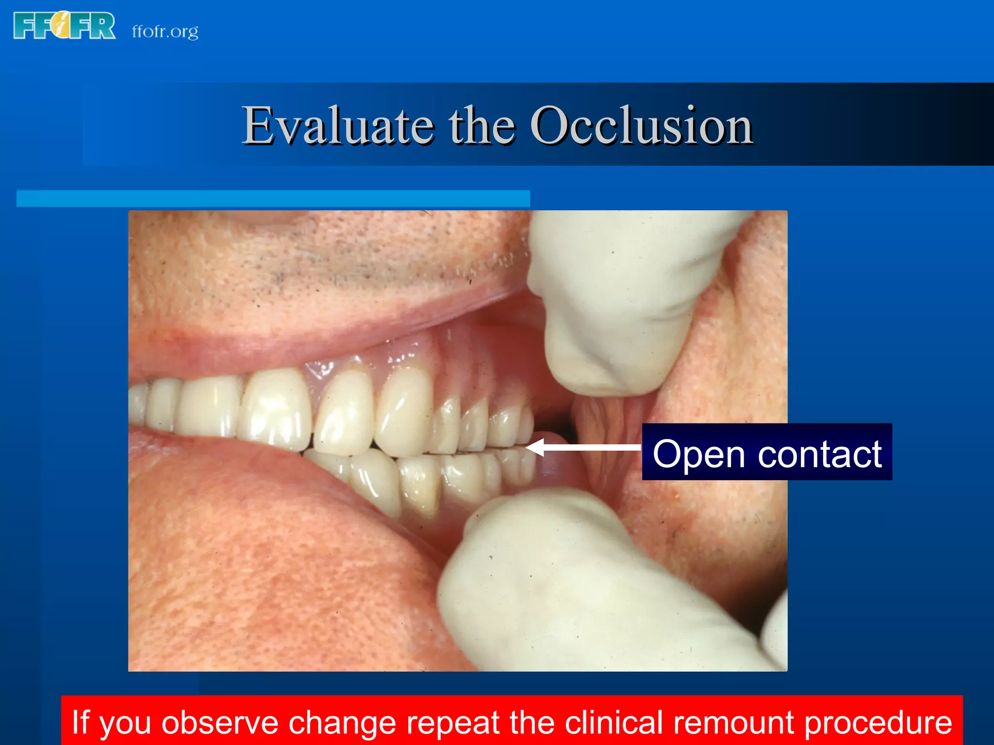 Evaluate the Occlusion If you observe change repeat the clinical remount procedure Open contact 