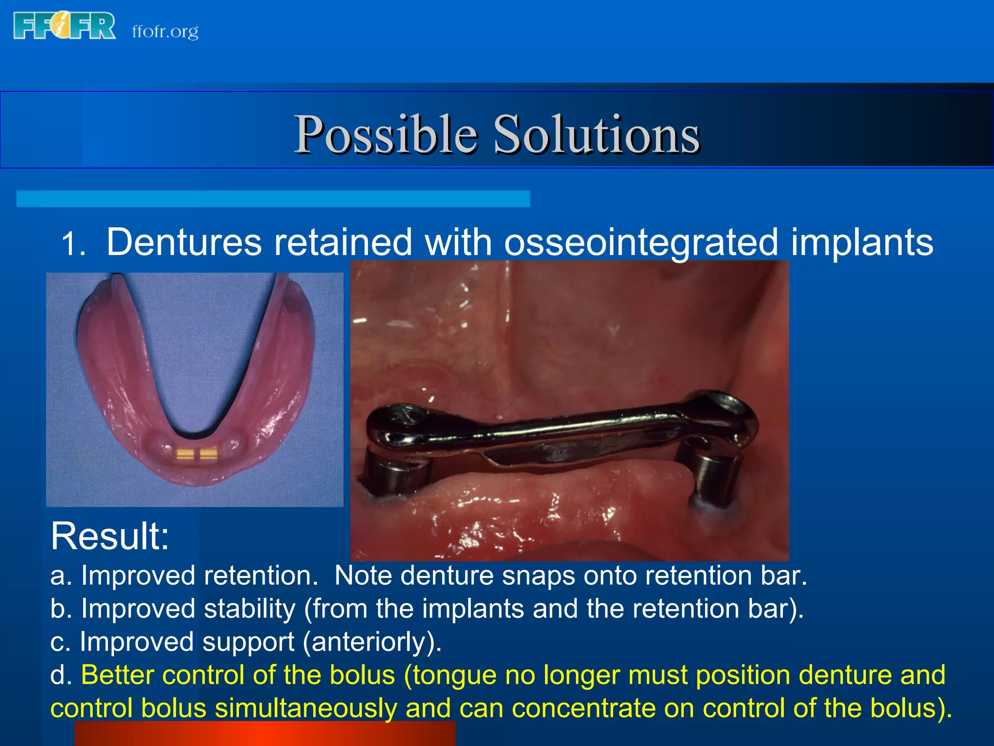 Result: a. Improved retention.  Note denture snaps onto retention bar. b. Improved stability (from the implants and the retention bar). c. Improved support (anteriorly). d.  Better control of the bolus (tongue no longer must position denture and control bolus simultaneously and can concentrate on control of the bolus). Possible Solutions 1.  Dentures retained with osseointegrated implants 