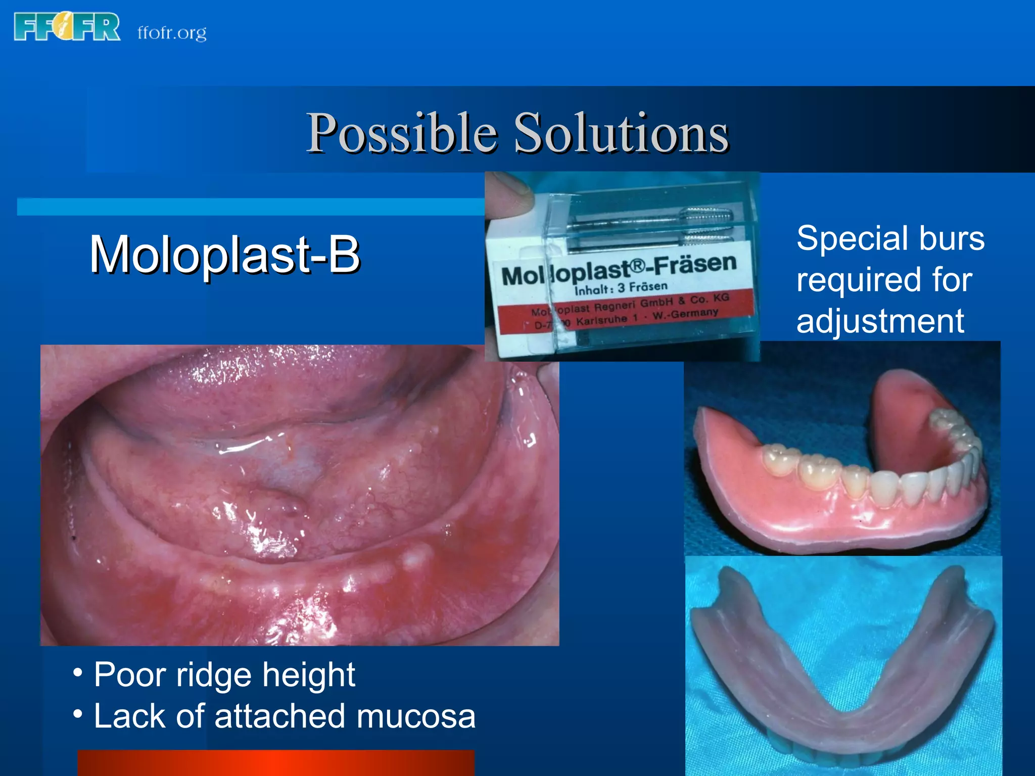 Moloplast-B Poor ridge height Lack of attached mucosa Special burs  required for  adjustment Possible Solutions 