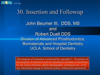 30. Insertion and Followup John Beumer III,  DDS, MS and Robert Duell DDS Division of Advanced Prosthodontics, Biomaterials and Hospital Dentistry UCLA  School of Dentistry This program of instruction is protected by copyright ©.  No portion of this program of instruction may be reproduced, recorded or transferred by any means electronic, digital, photographic, mechanical etc., or by any information storage or retrieval system, without prior permission. 