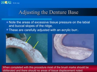 Note the areas of excessive tissue pressure on the labial and buccal slopes of the ridge. These are carefully adjusted with an acrylic burr . Adjusting the Denture Base When completed with this procedure most of the brush marks should be obliterated and there should no areas of tissue displacement noted. 