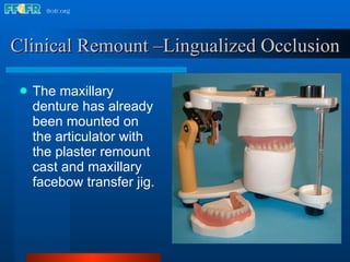 The maxillary denture has already been mounted on the articulator with the plaster remount  cast and maxillary facebow transfer jig. Clinical Remount –Lingualized Occlusion 
