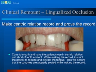 Carry to mouth and have the patient close in centric relation just short of tooth contact.  While making the record, instruct the patient to retrude and elevate the tongue.  This will ensure that the condyles are properly seated while making the record. Clinical Remount – Lingualized Occlusion Make centric relation record and prove the record 
