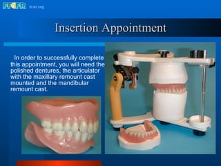 Insertion Appointment In order to successfully complete this appointment, you will need the polished dentures, the articulator with the maxillary remount cast mounted and the mandibular remount cast. 