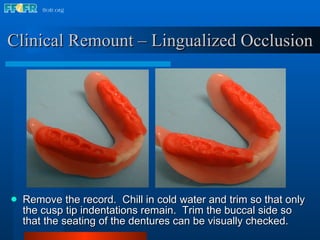 Remove the record.  Chill in cold water and trim so that only the cusp tip indentations remain.  Trim the buccal side so that the seating of the dentures can be visually checked. Clinical Remount – Lingualized Occlusion 