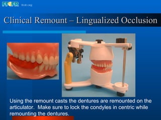Clinical Remount – Lingualized Occlusion Using the remount casts the dentures are remounted on the articulator.  Make sure to lock the condyles in centric while remounting the dentures. 