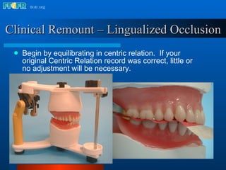 Clinical Remount – Lingualized Occlusion Begin by equilibrating in centric relation.  If your original Centric Relation record was correct, little or no adjustment will be necessary. 
