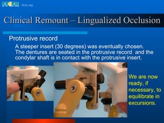 Clinical Remount – Lingualized Occlusion Protrusive record A steeper insert (30 degrees) was eventually chosen.  The dentures are seated in the protrusive record  and the condylar shaft is in contact with the protrusive insert. We are now ready, if necessary, to equilibrate in excursions . 