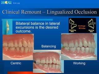 Clinical Remount – Lingualized Occlusion Bilateral balance in lateral excursions is the desired outcome. Working Balancing Centric 