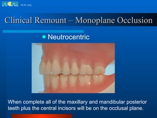 Clinical Remount – Monoplane Occlusion Neutrocentric When complete all of the maxillary and mandibular posterior teeth plus the central incisors will be on the occlusal plane.  