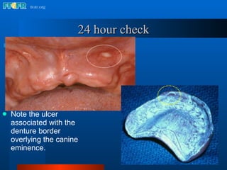 24 hour check Note the ulcer associated with the denture border overlying the canine eminence. 