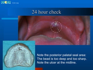 Note the posterior palatal seal area: The bead is too deep and too sharp.  Note the ulcer at the midline. 24 hour check 