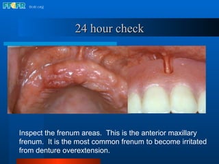 24 hour check Inspect the frenum areas.  This is the anterior maxillary frenum.  It is the most common frenum to become irritated from denture overextension. 