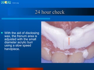 With the aid of disclosing wax, the frenum area is adjusted with the small diameter acrylic burr using a slow speed handpiece . 24 hour check 