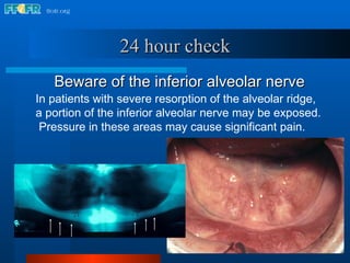 Beware of the inferior alveolar nerve 24 hour check In patients with severe resorption of the alveolar ridge,  a portion of the inferior alveolar nerve may be exposed.  Pressure in these areas may cause significant pain. 