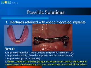 Result: a. Improved retention.  Note denture snaps onto retention bar. b. Improved stability (from the implants and the retention bar). c. Improved support (anteriorly). d.  Better control of the bolus (tongue no longer must position denture and control bolus simultaneously and can concentrate on control of the bolus). Possible Solutions 1.  Dentures retained with osseointegrated implants 